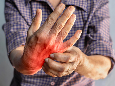 Rheumatoid Arthritis1